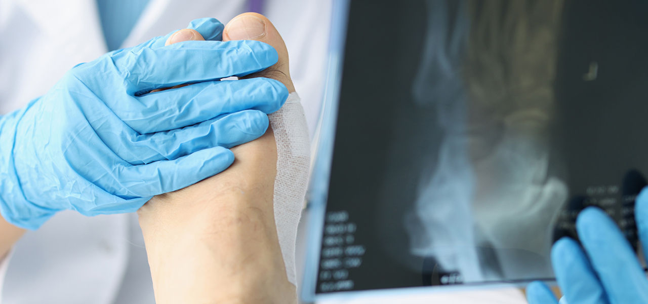 doctor's gloved hands hold a patient's bandaged foot next to xrays of the foot